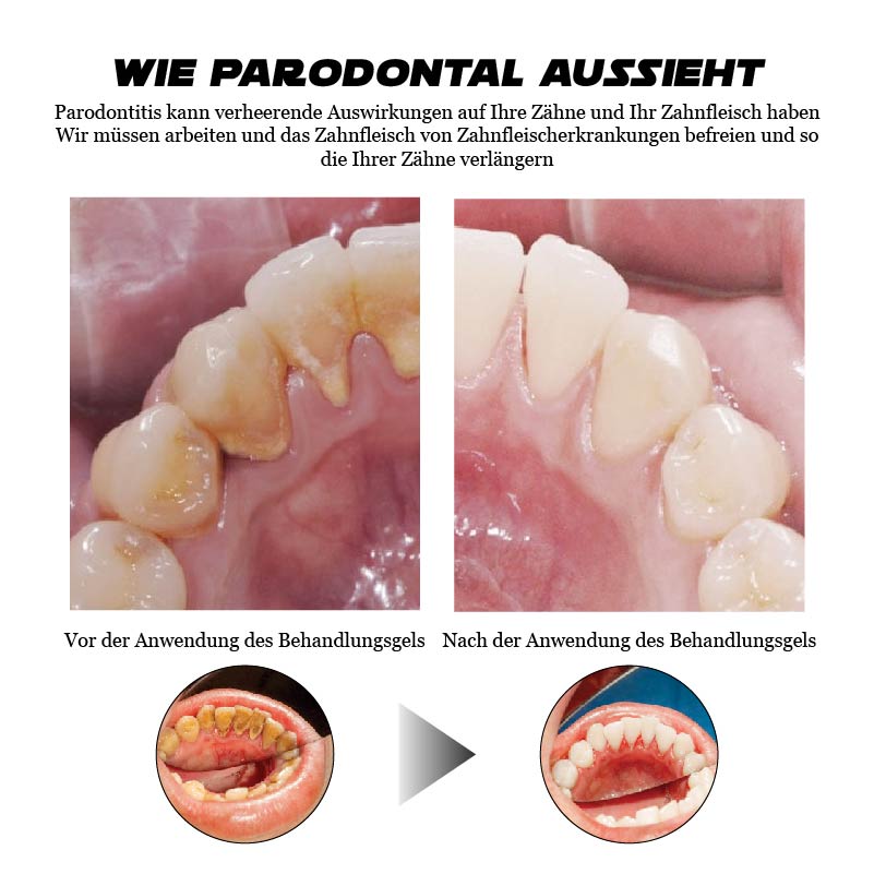 ATTDX GumErleichterung ParodontalBehandlung Gel