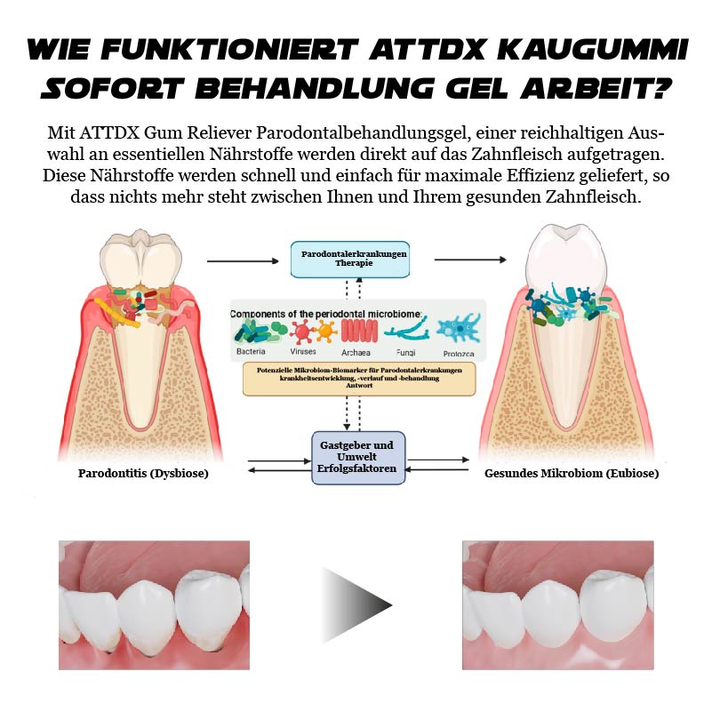 ATTDX GumErleichterung ParodontalBehandlung Gel