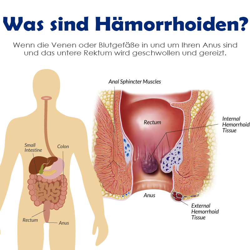 ATTDX SofortHeilung NatürlicheKräuter HämorrhoidenKapseln