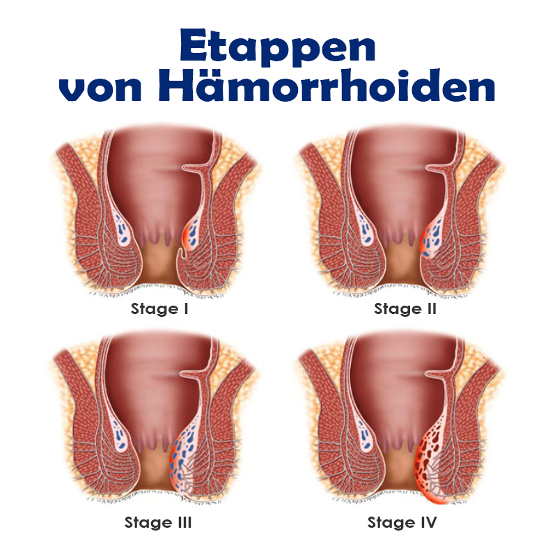 ATTDX SofortHeilung NatürlicheKräuter HämorrhoidenKapseln