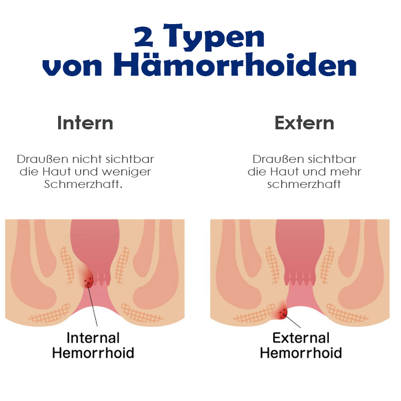 ATTDX SofortHeilung NatürlicheKräuter HämorrhoidenKapseln