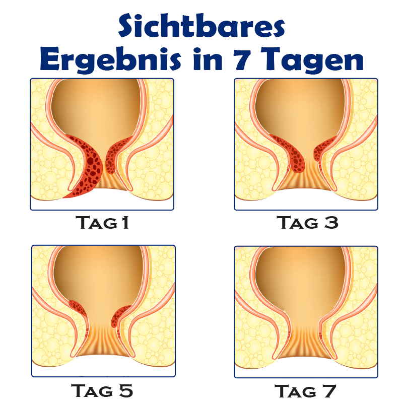 ATTDX SofortHeilung NatürlicheKräuter HämorrhoidenKapseln