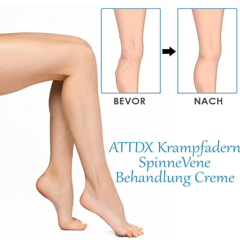 ATTDX Krampfadern SpinneVene Behandlung Creme