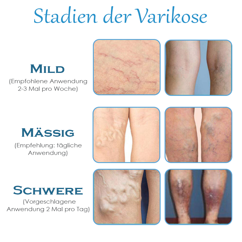 ATTDX Krampfadern SpinneVene Behandlung Creme