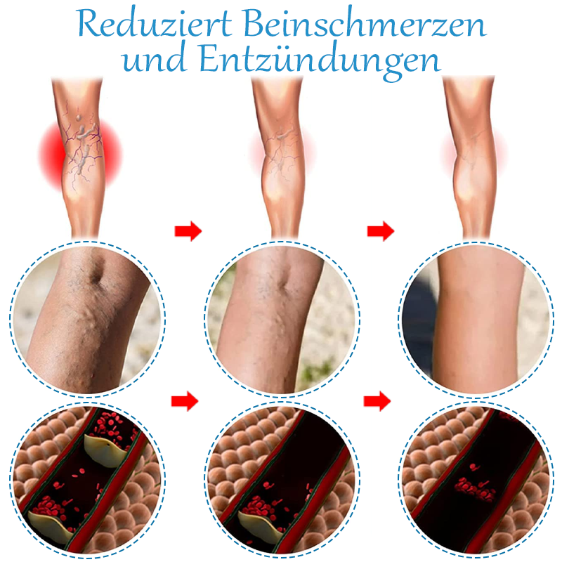 ATTDX Krampfadern SpinneVene Behandlung Creme