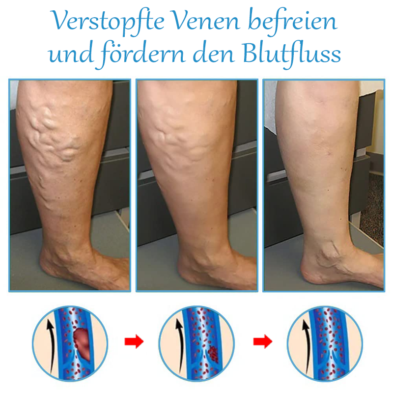 ATTDX Krampfadern SpinneVene Behandlung Creme