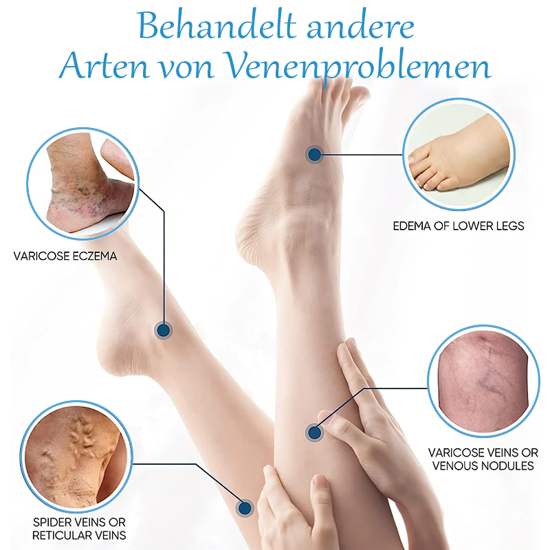 ATTDX Krampfadern SpinneVene Behandlung Creme