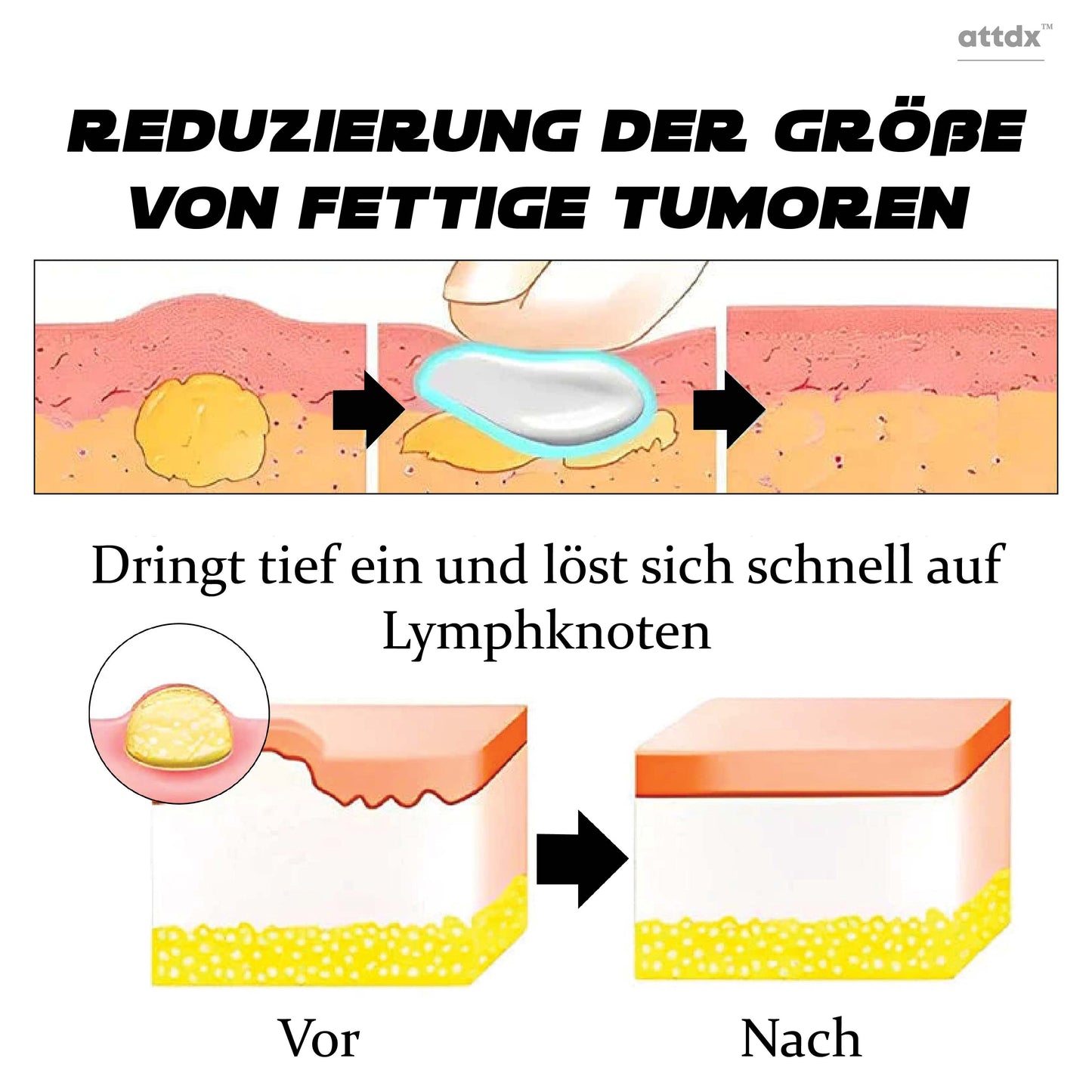 ATTDX Lymphknoten BildhauerischeEntwässerung Entgiftungscreme