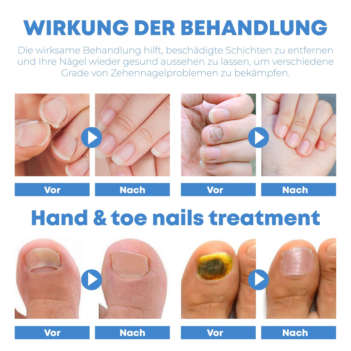 ATTDX NagelReparaturFeuchtigkeitscreme Behandlung Aufnäher