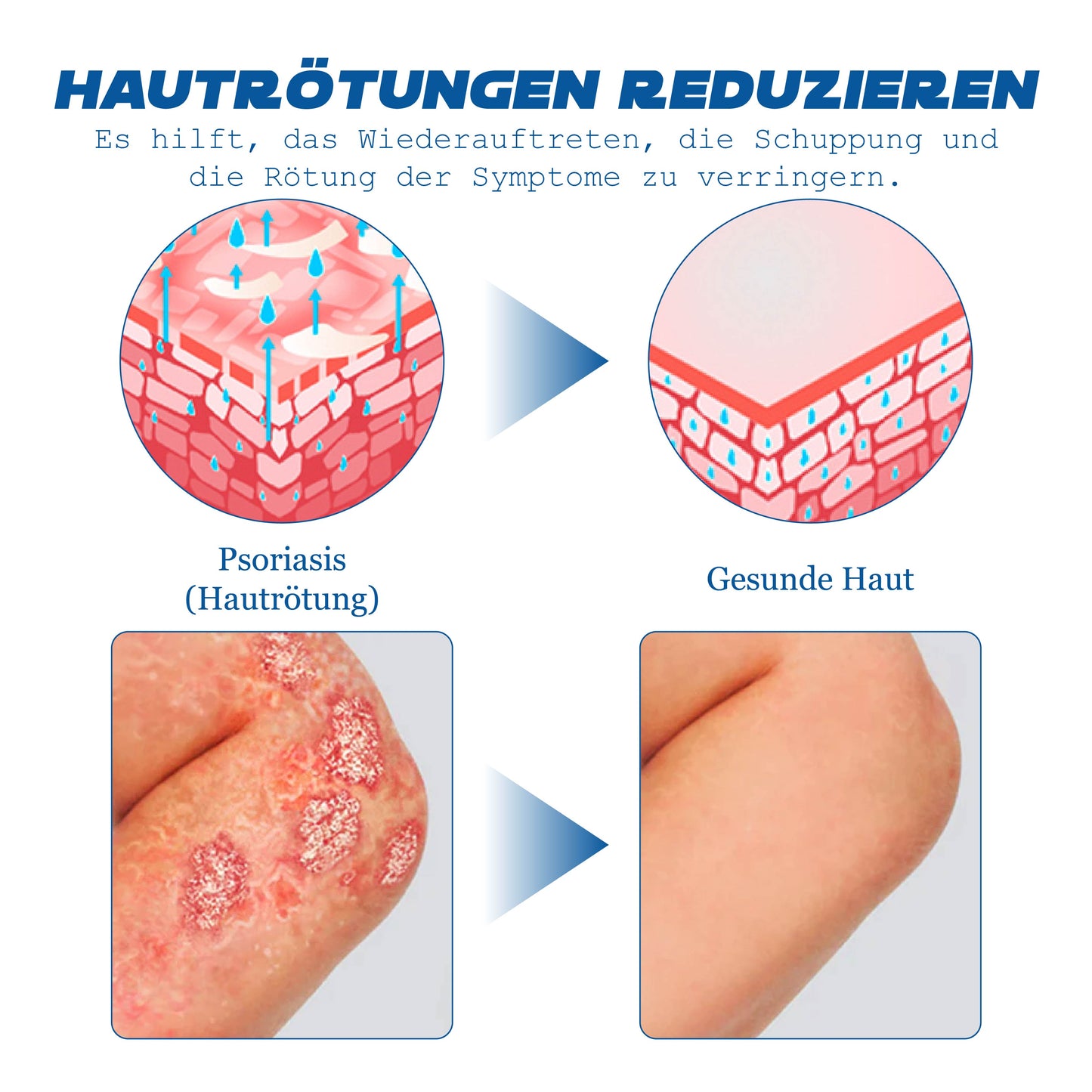 ATTDX Psoriasis Behandlung BieneVenom Creme