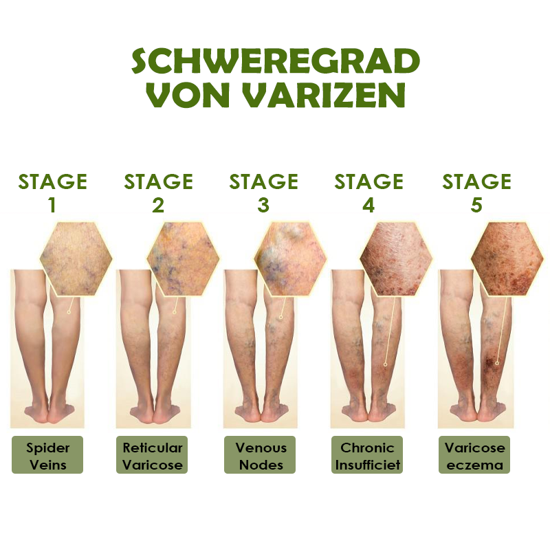 ATTDX SofortErleichterung VarizenAder Creme