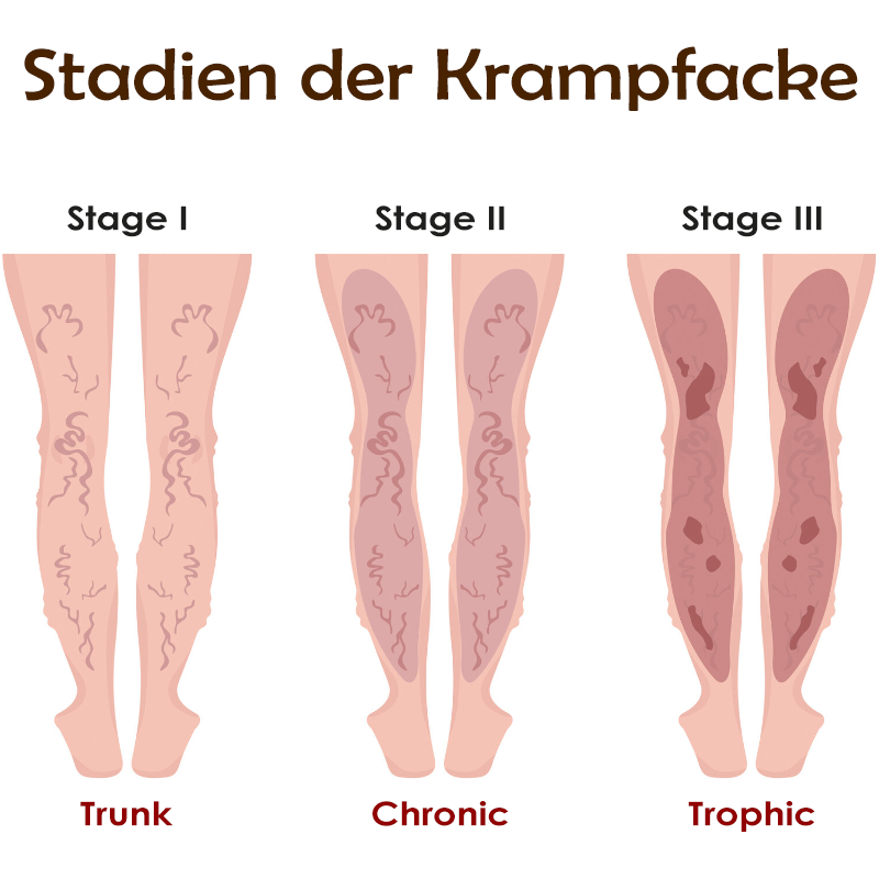 ATTDX Varizen Venen Behandlung Creme