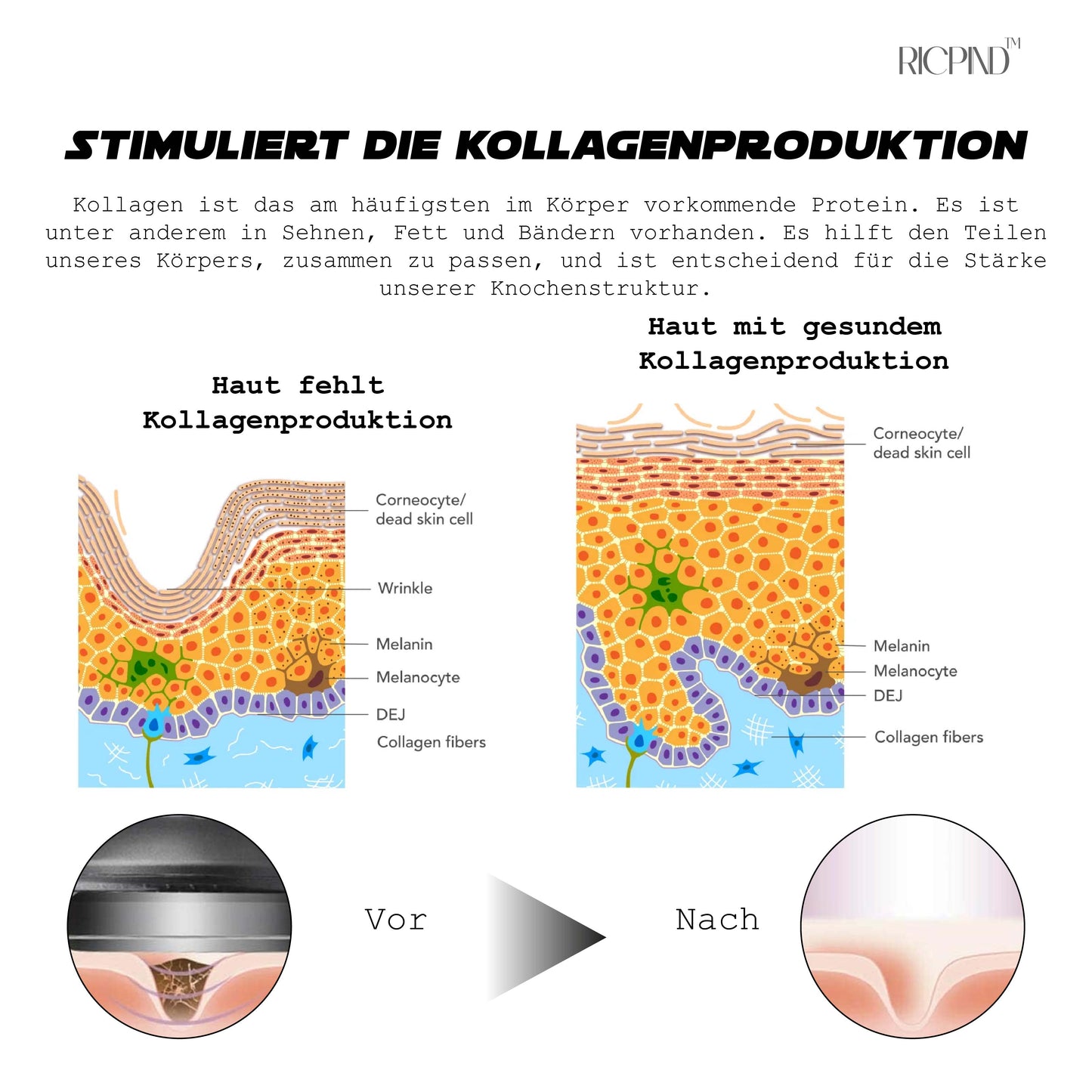 RICPIND Ultimativ Kaltlaser ThermaHeilung Entlastungsvorrichtung