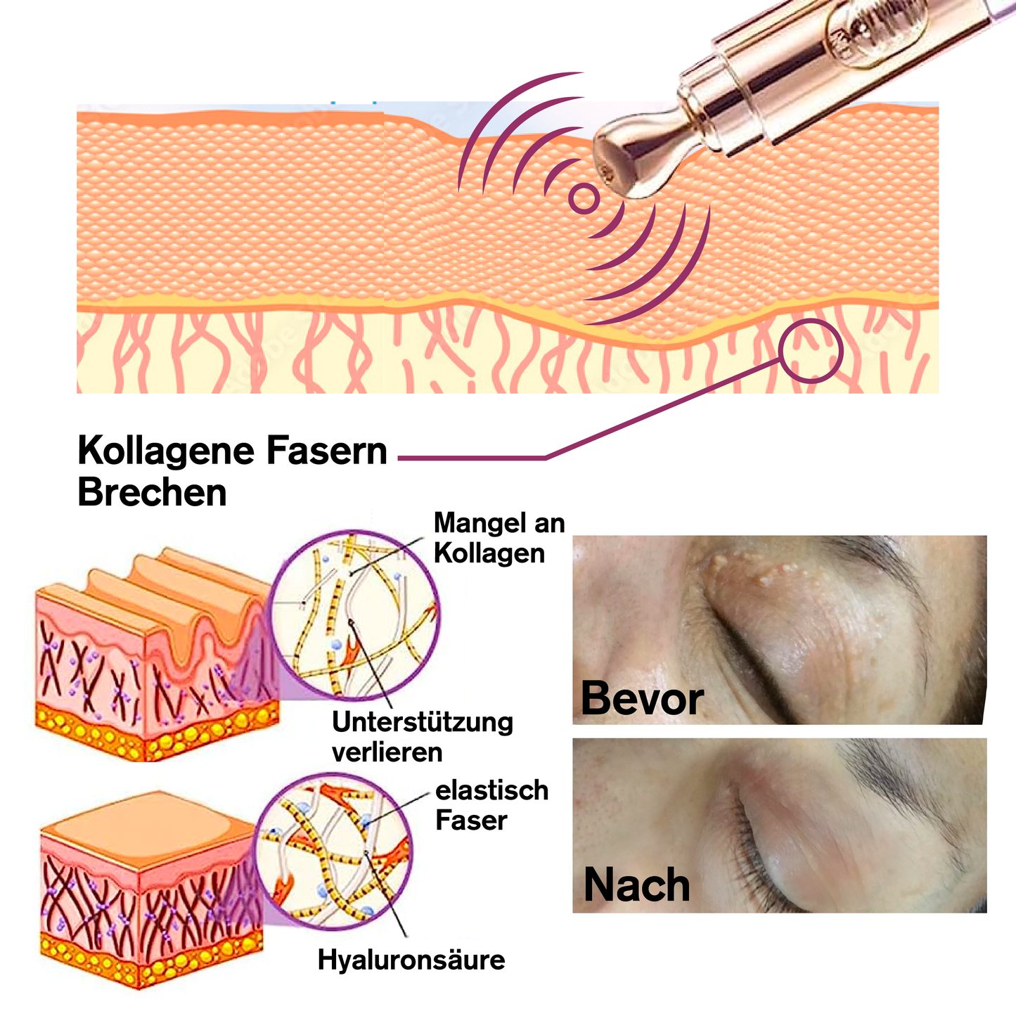 ATTDX MilchFlecken Behandlung ElektrischSerum Stift