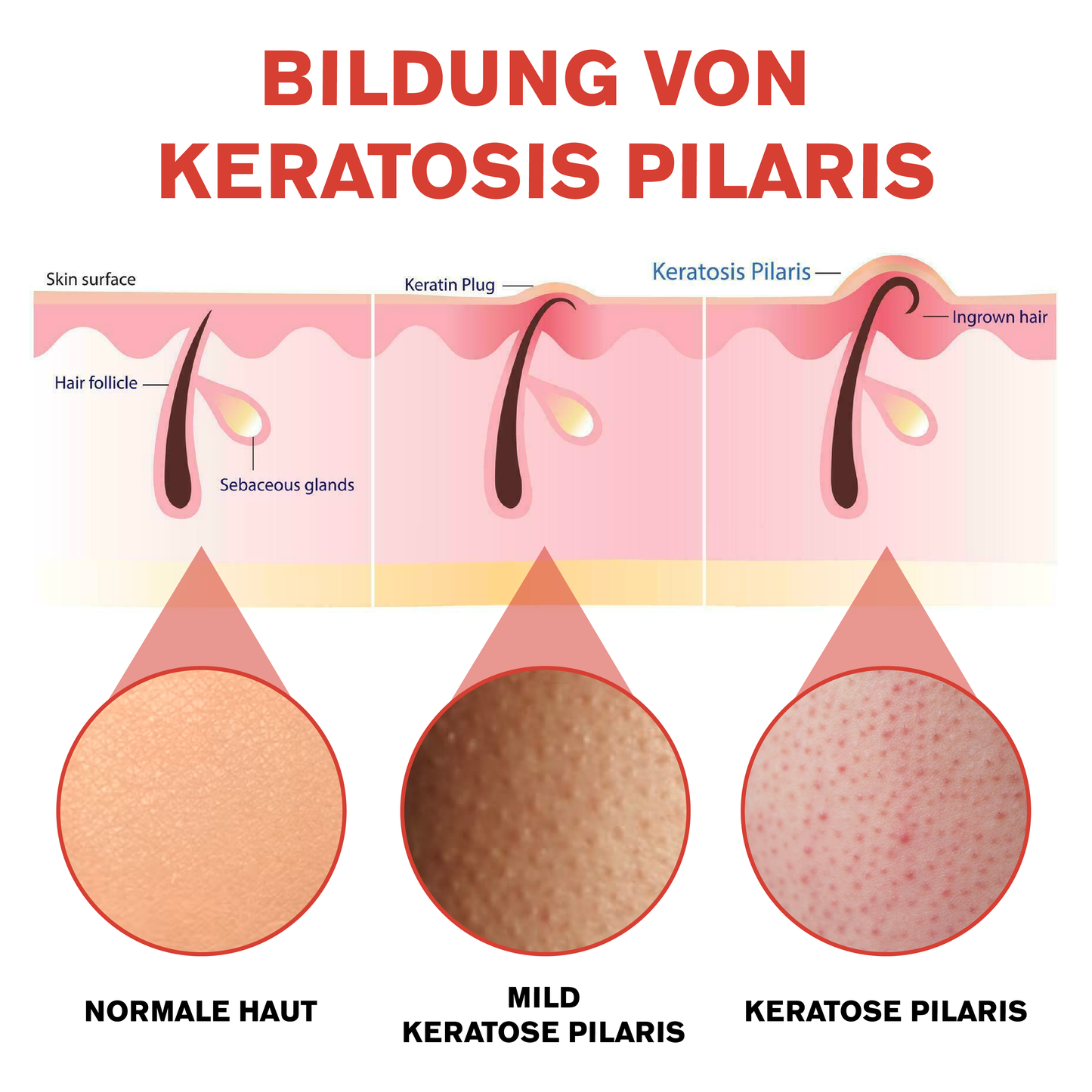 ATTDX Tief KeratoseReinigungsmittel GlatteCreme