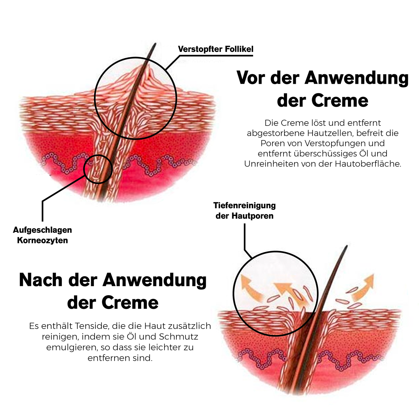 ATTDX Tief KeratoseReinigungsmittel GlatteCreme