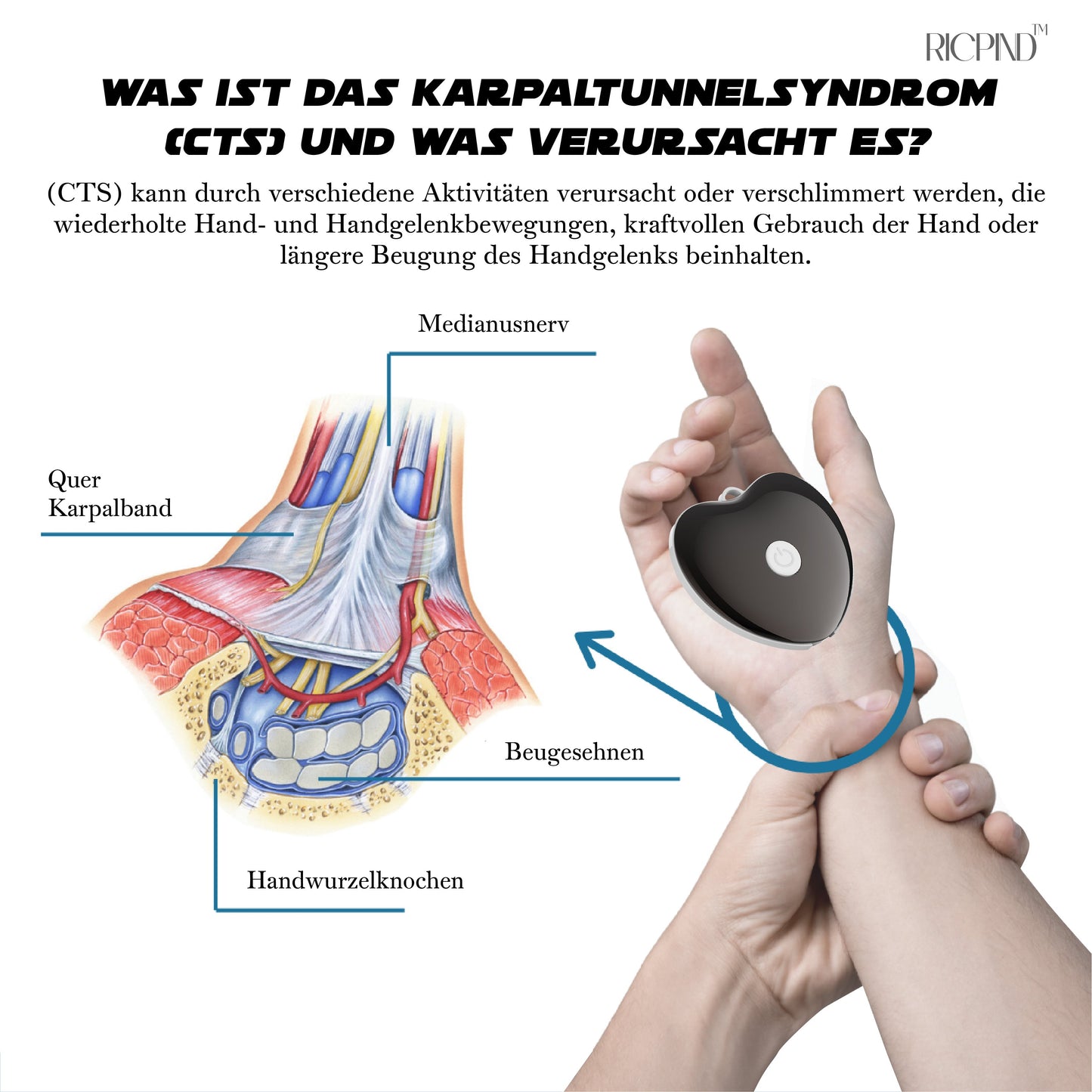 RICPIND Nervenentlastung Karpaltunnel-Therapiegerät